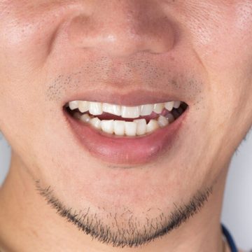 Treatment of Facial Trauma Is Necessary to Avoid Significant Problems