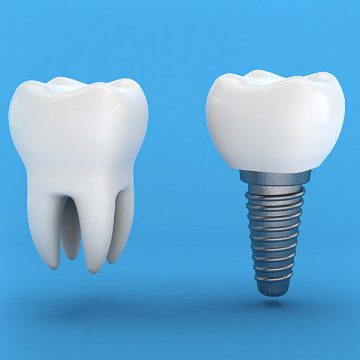 Why Should You Choose an Oral Surgeon Over a General Dentist for Dental Implants?