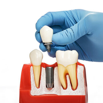 What are Dental Implants? Types, Procedures, and More
