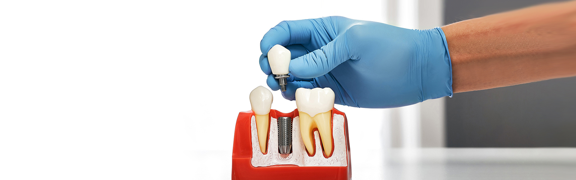 What are Dental Implants? Types, Procedures, and More